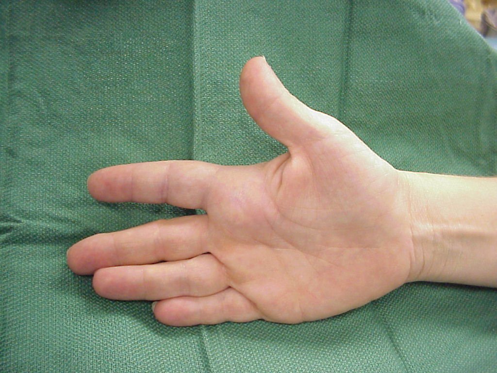Top 5 Tendon Gliding Exercises for Hand and Finger Health
