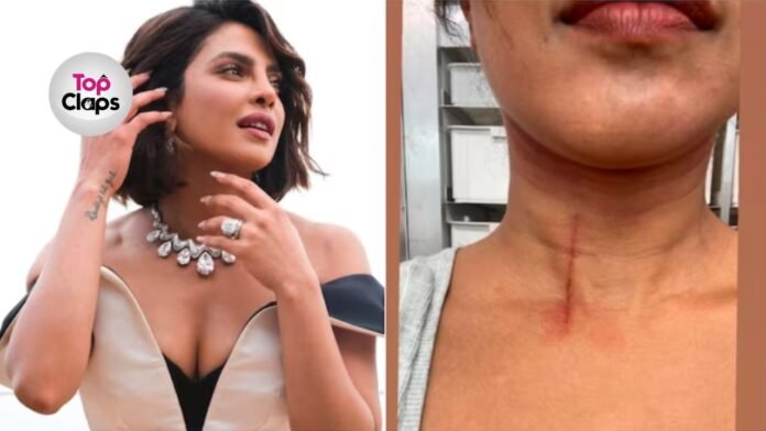 Priyanka Chopra Injured On Set, Shares Updates